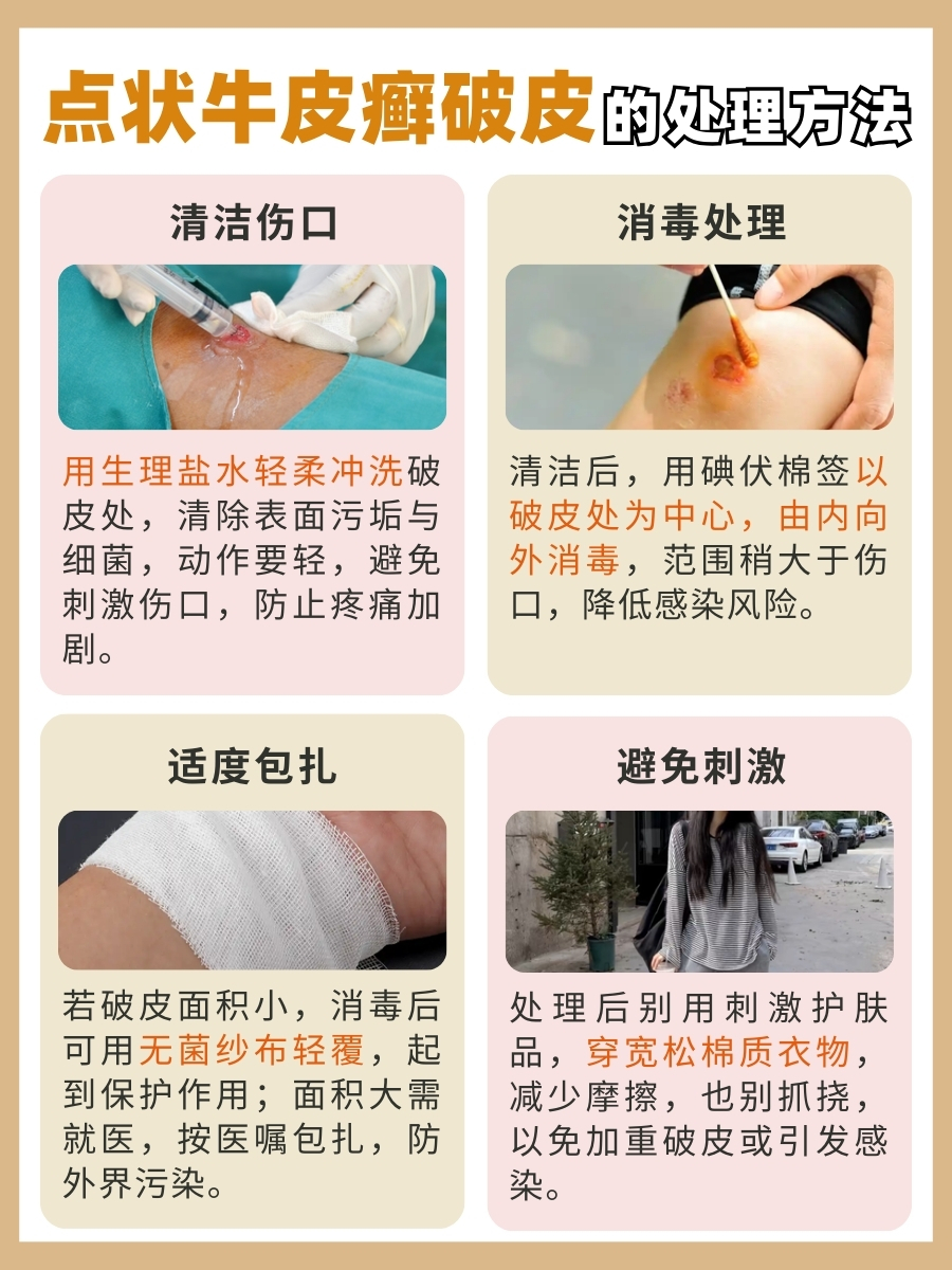 快看!点状牛皮癣破皮,究竟啥状况?