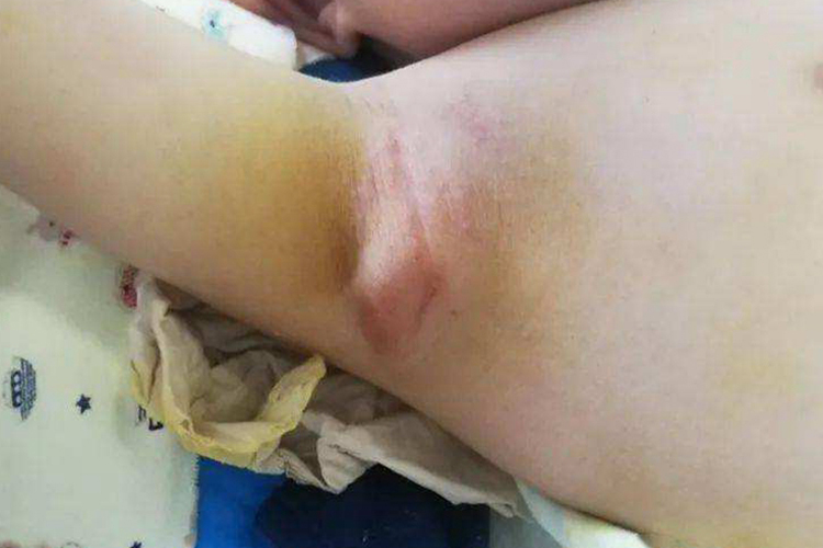 儿童腋下淋巴结炎图 儿童腋下淋巴结炎图