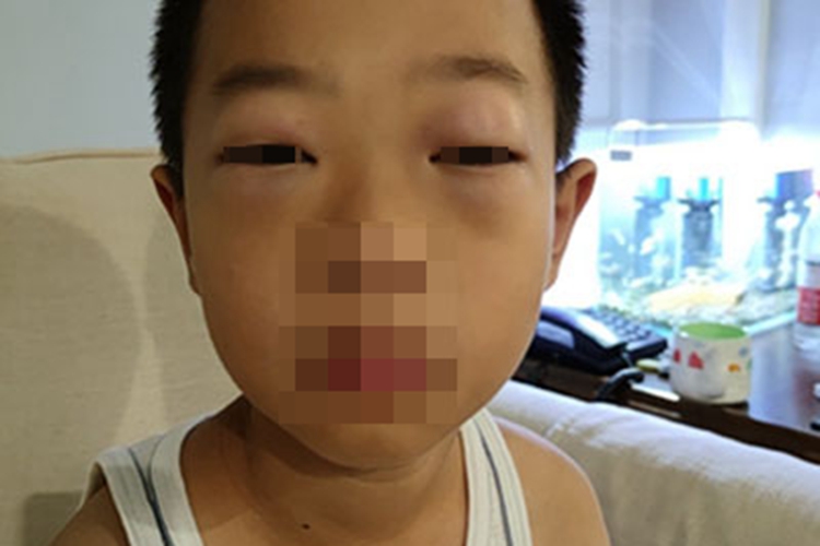 过敏性眼睑皮肤炎眼睑水肿图