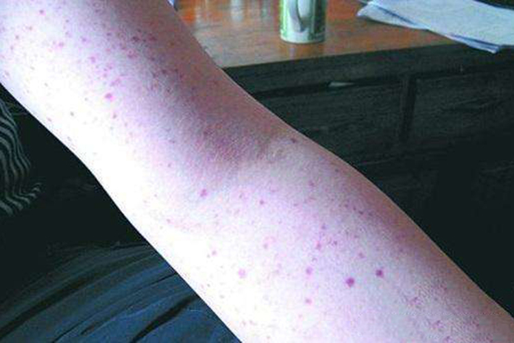 特发性血小板减少性紫癜图