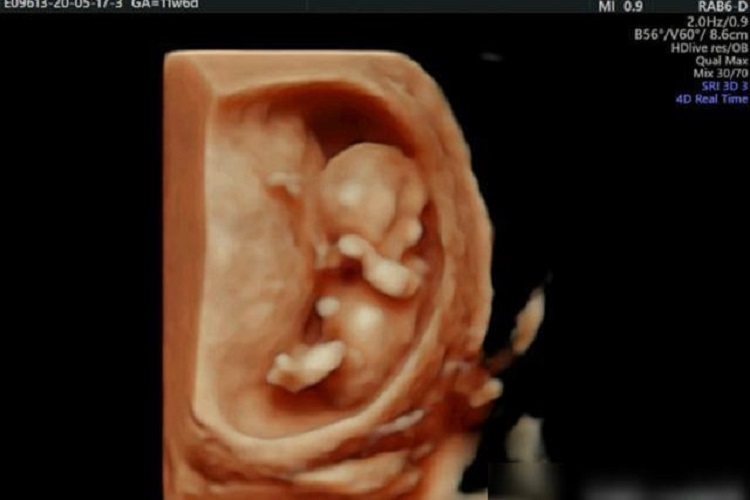 孕十三周胎儿影像图