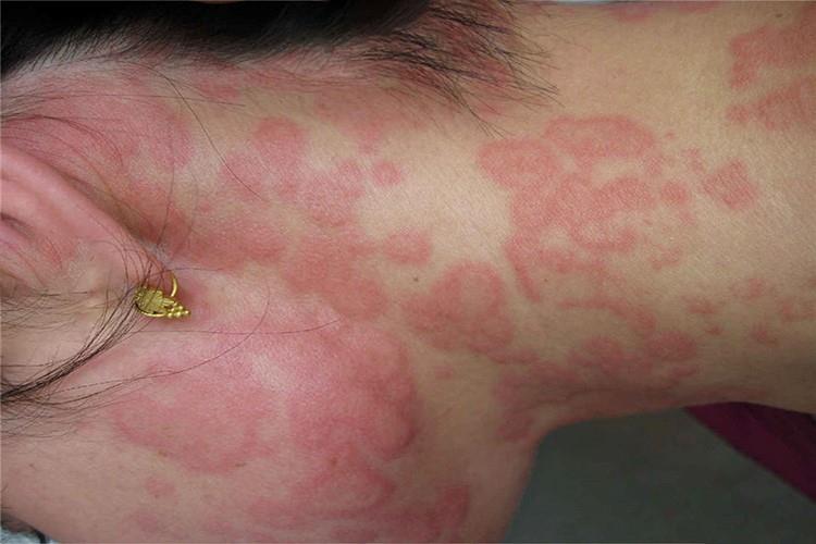 为什么不建议用炎琥宁