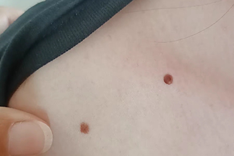 皮内痣肩部小疙瘩图