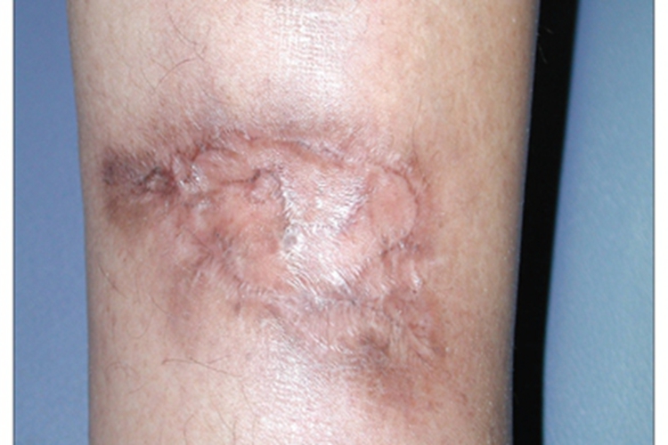 硬结性红斑症状图 硬结性红斑症状图