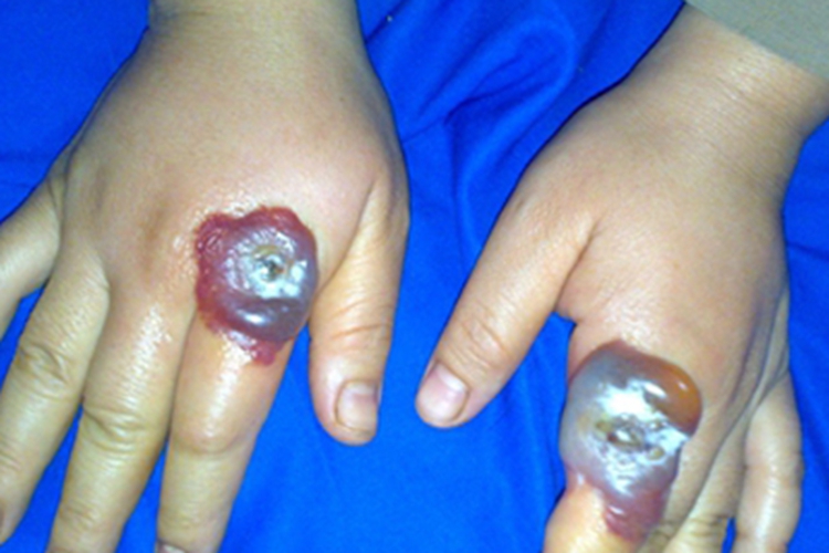 羊痘手部有肿大的包块图