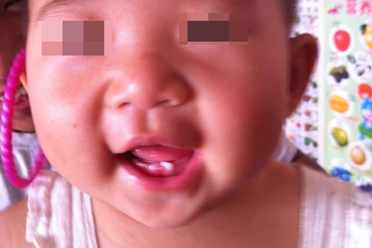 乳牙歪斜图 乳牙歪斜图