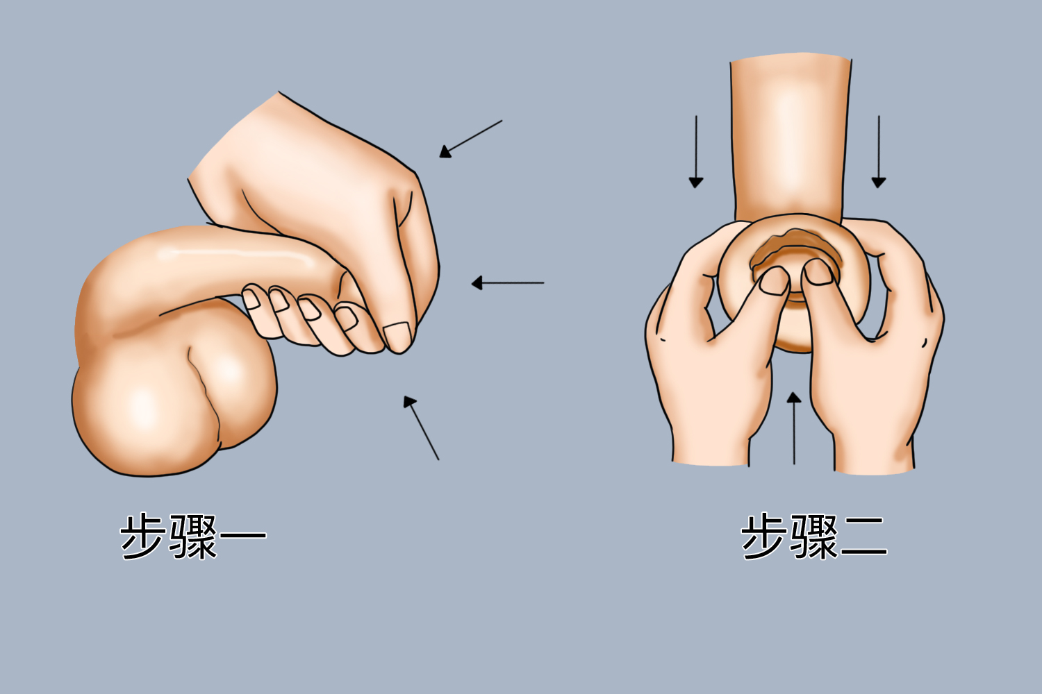嵌顿包茎怎么自己解决图片