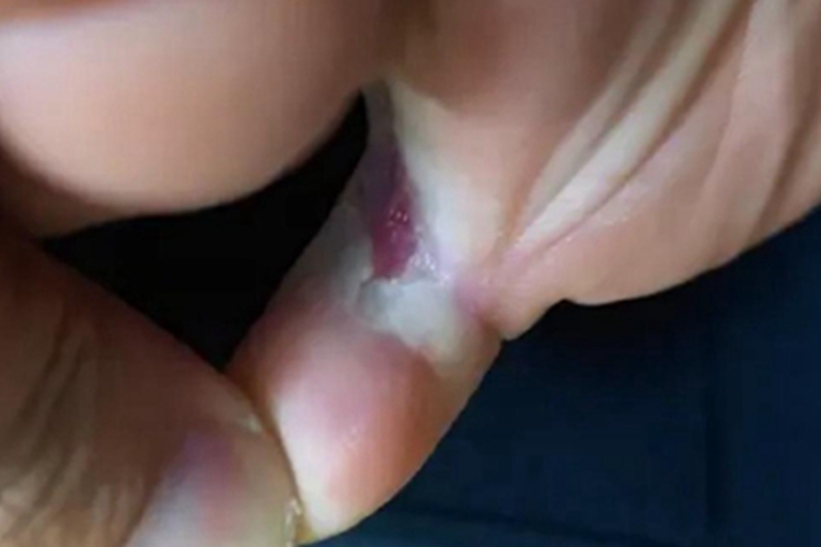 糜烂型足癣脚趾缝糜烂图