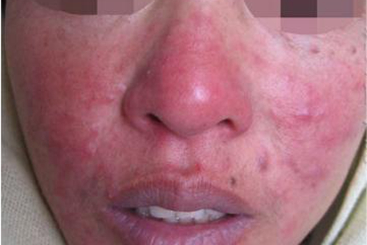 蠕形螨病面部脓包图 蠕形螨病面部脓包图