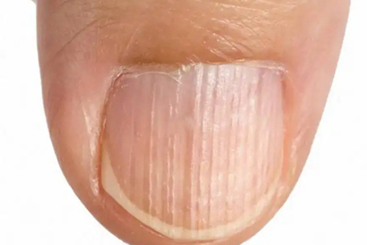 先天性角化不良指甲盖粗糙竖纹图