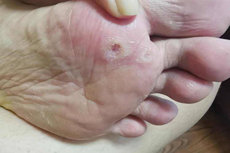 疣脚底皮肤增厚图