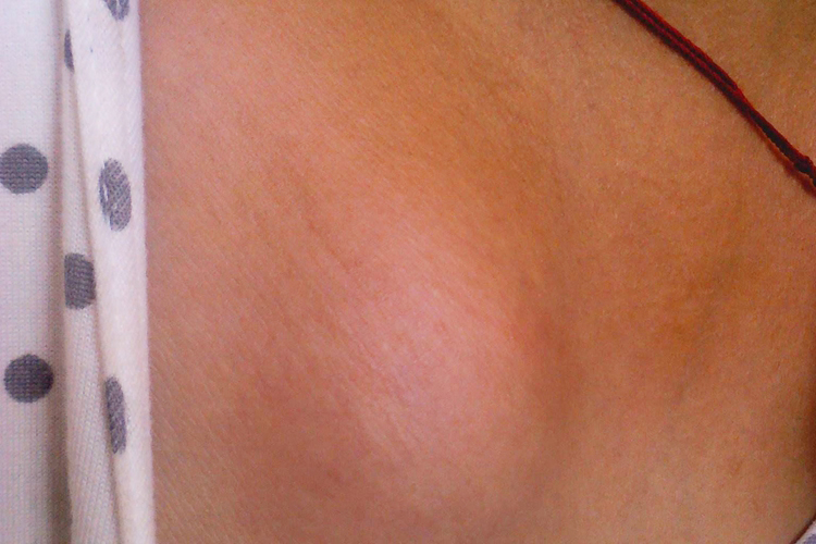 纤维瘤图 纤维瘤图