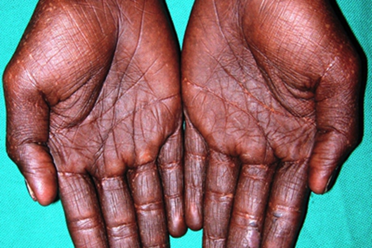 遗传性泛发性色素异常症手掌黑图