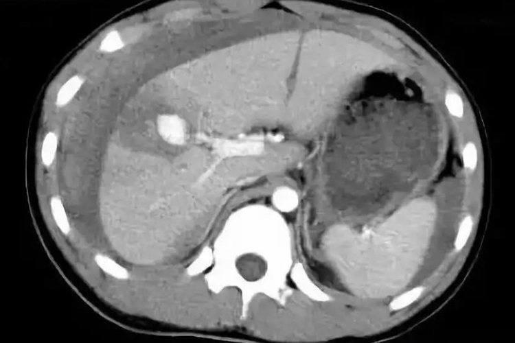 肝破裂出血被膜撕裂CT图 肝破裂出血被膜撕裂CT图