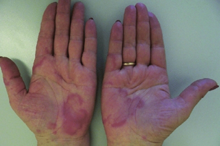 荨麻疹性血管炎手掌红斑图 荨麻疹性血管炎手掌红斑图