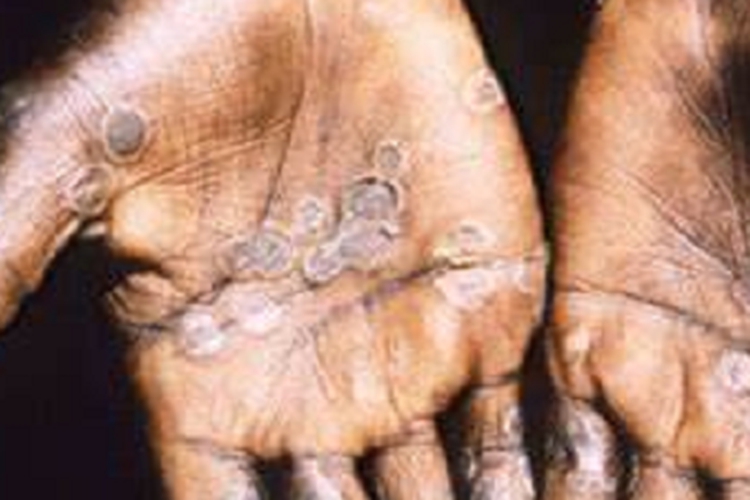 天花手掌圆形瘢痕图