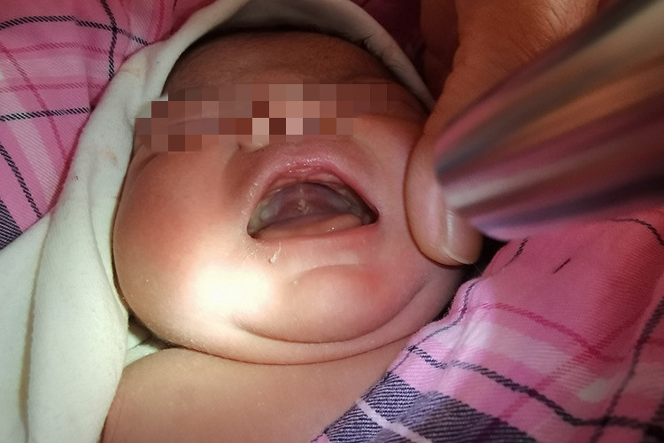 上颚中线附近马牙图