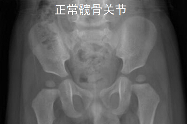 儿童髋关节X线检查图