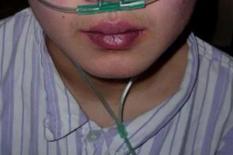 感染性休克嘴唇发绀图 感染性休克嘴唇发绀图