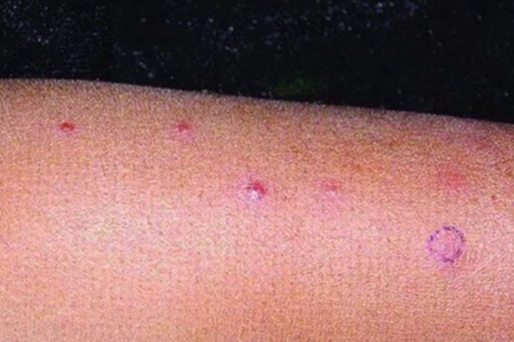 巴尔通体病胳膊丘疹图