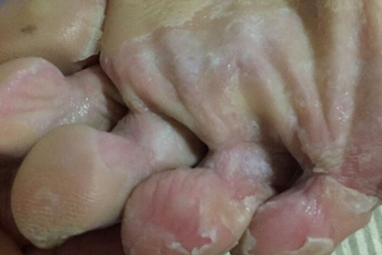 浸渍糜烂型足癣脚底脱皮图