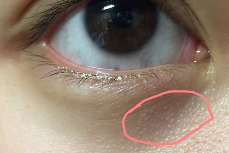 粟丘疹图 粟丘疹图