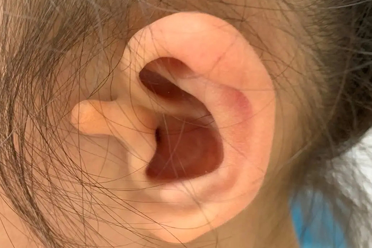 附耳切除前图 附耳切除前图