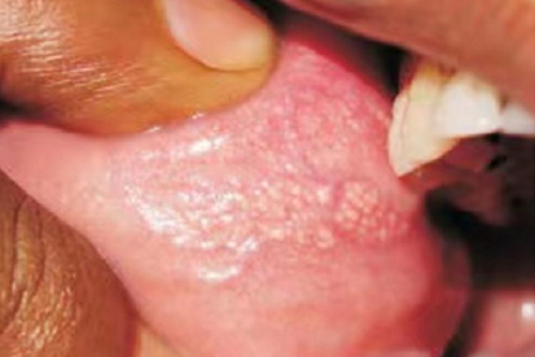 异位皮脂腺口腔症状图