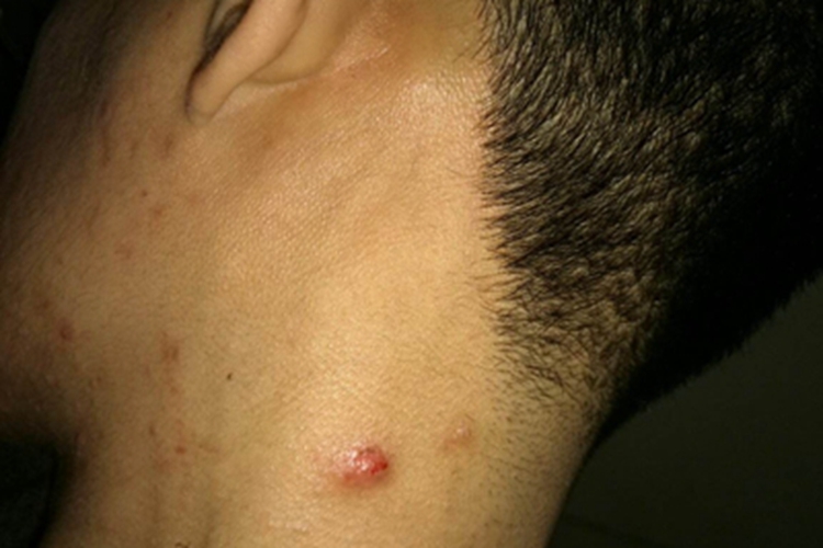 网状组织细胞肉芽肿症状图 网状组织细胞肉芽肿症状图