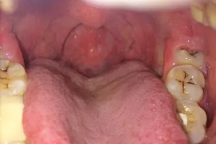 淋菌性咽炎症状图