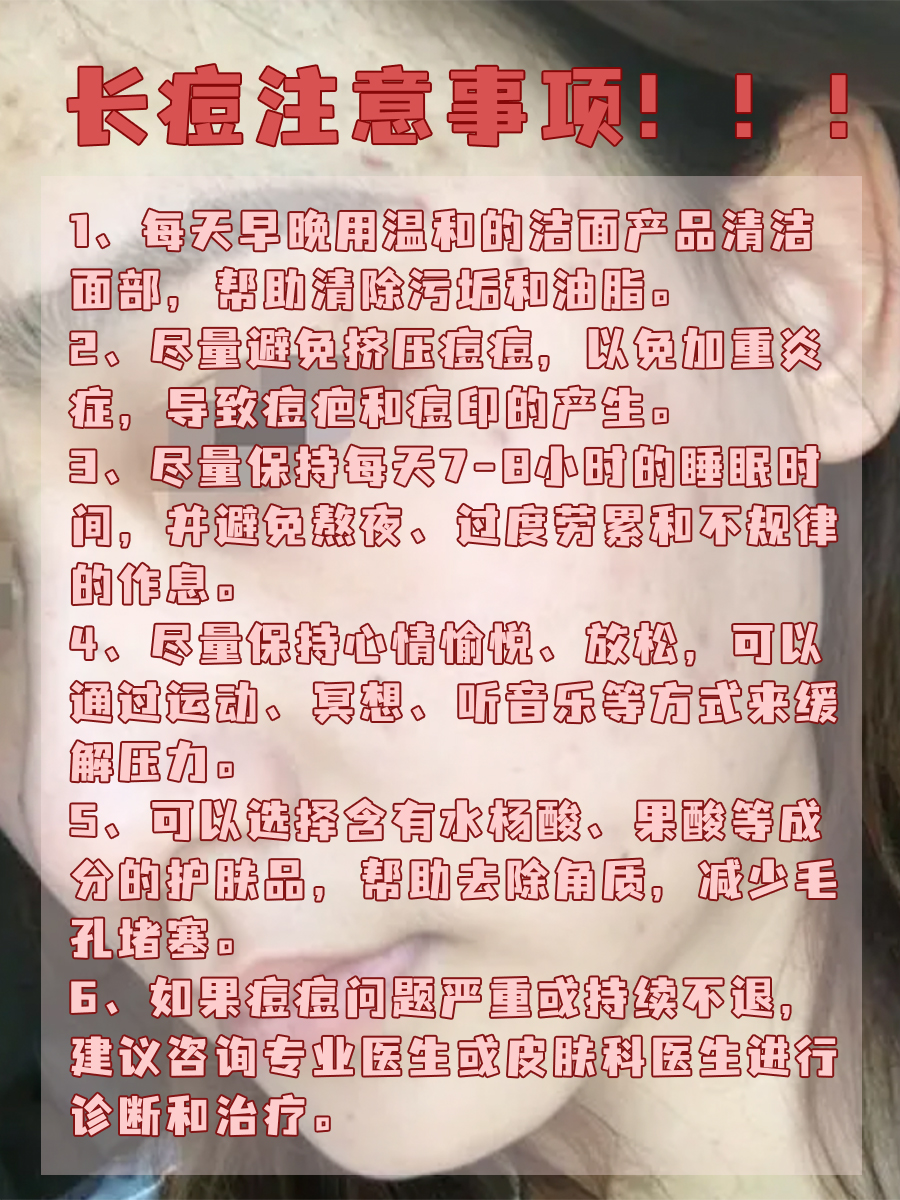 痘痘位置告诉你：身体哪里出了问题？一图读懂！