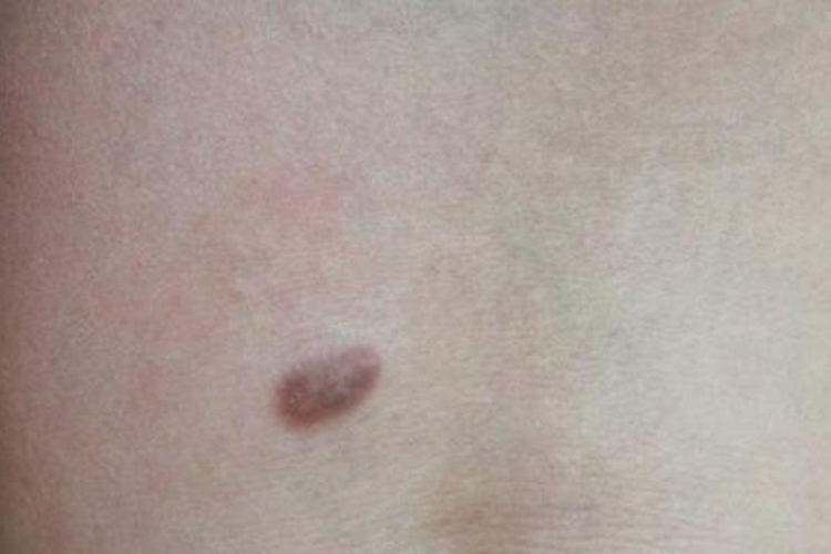 腰部卡波西肉瘤图