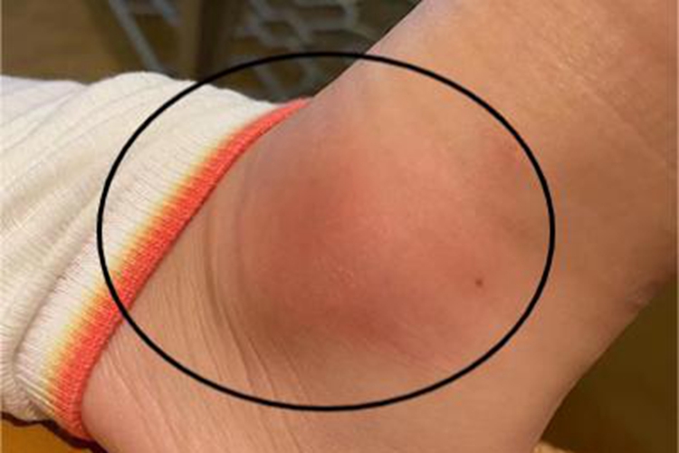 皮肤型结节性多动脉炎脚踝红肿图 皮肤型结节性多动脉炎脚踝红肿图