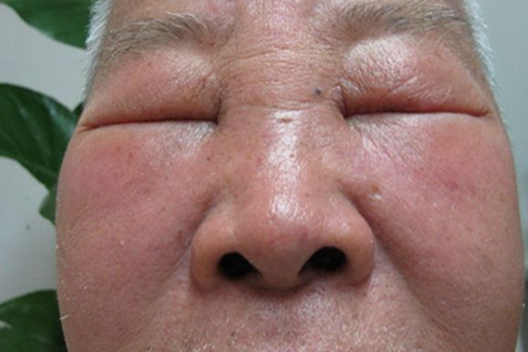 旋毛虫病症状图