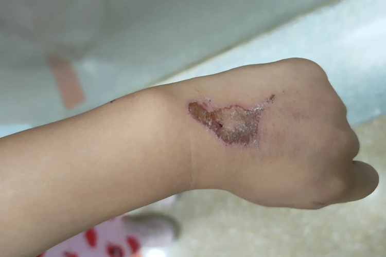 小孩手背擦伤结痂图 小孩手背擦伤结痂图