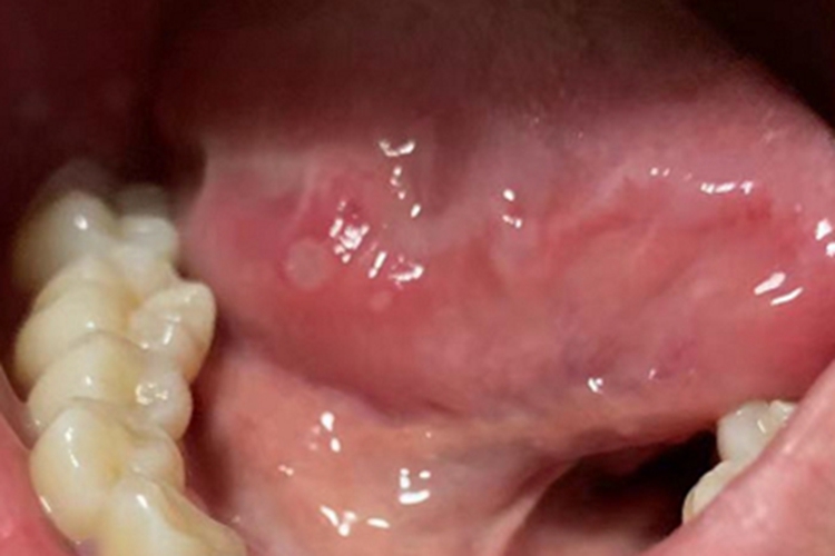 轻型阿弗他溃疡舌侧白点图