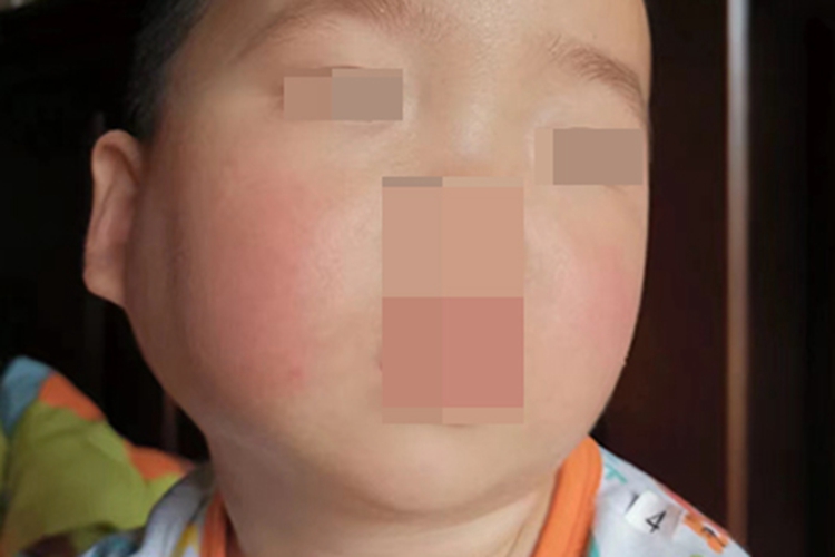 儿童复发性腮腺炎一侧脸有肿块图
