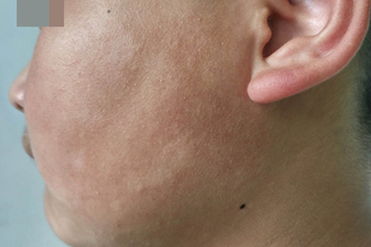 虫斑左脸上有很多白斑图