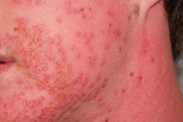 昆虫性皮炎面部症状图