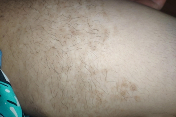 表皮痣大腿症状图