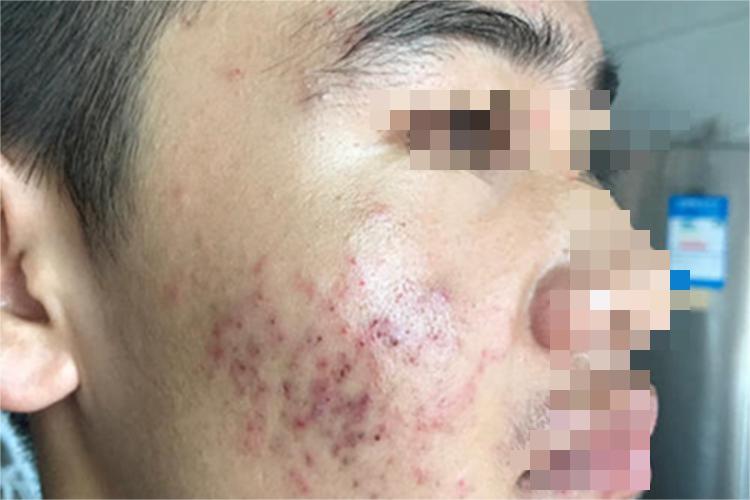 痤疮面部黑痂图 痤疮面部黑痂图