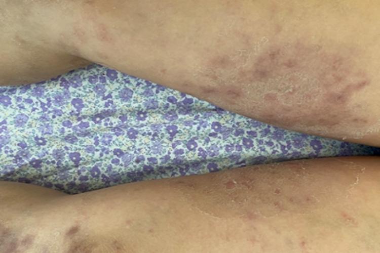 苔藓状淀粉样变大腿症状图