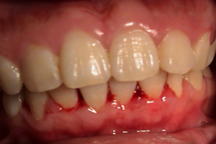 苯中毒牙龈症状图 苯中毒牙龈症状图