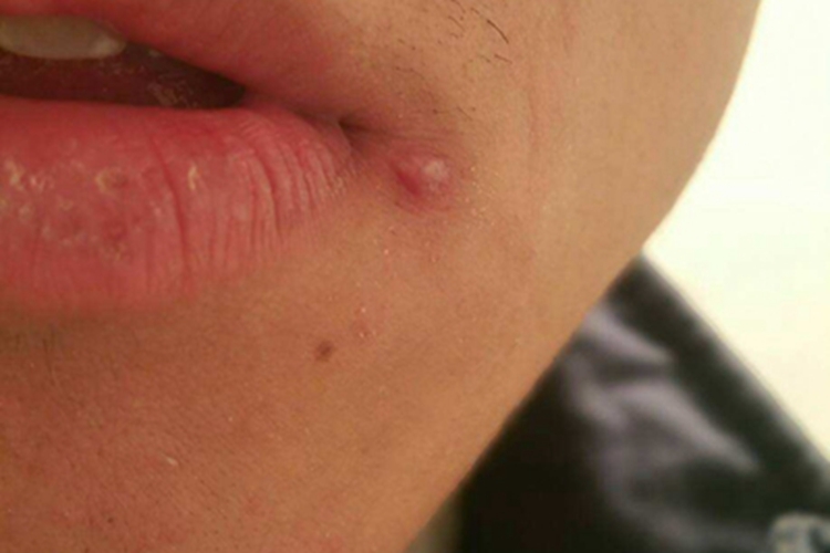 感染性口角炎嘴唇疙瘩图 感染性口角炎嘴唇疙瘩图