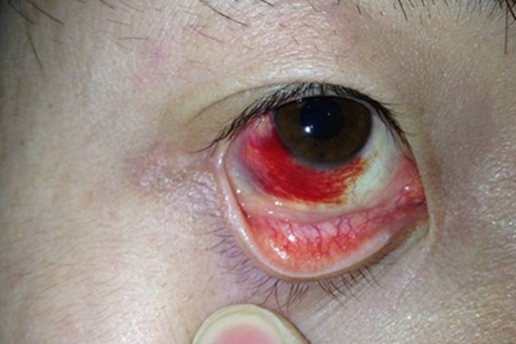 混合型春季角结膜炎症状图