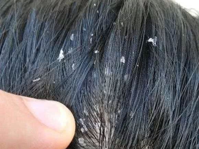 头皮糠疹头上很多皮屑图.jpg