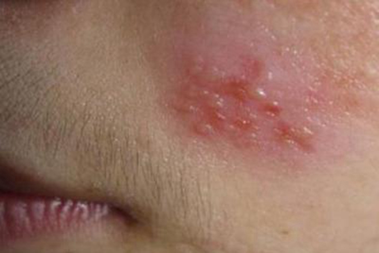 单纯疱疹面部症状图