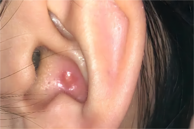 外耳道长痘痘图