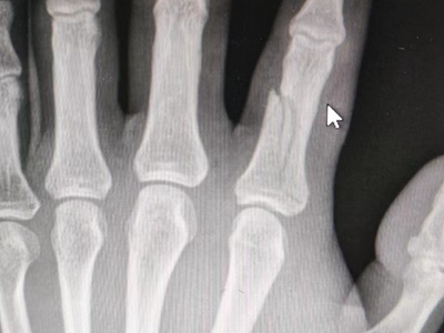 骨折手指的骨头局部断裂有裂纹图.jpg