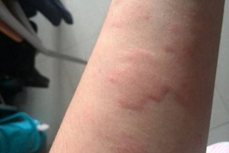 脓毒败血症疹胳膊大红疙瘩图